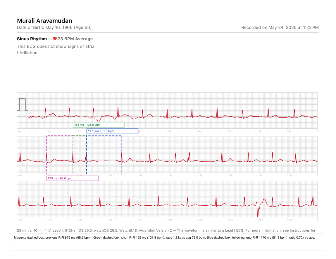 Input ECG short R-R followed by long R-R annotation